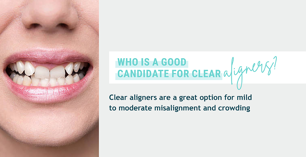 Real Life Examples Do Clear Aligners Really Work? EZ SMILE
