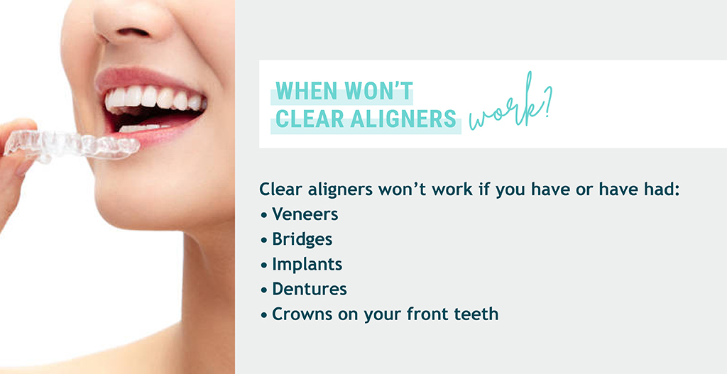 Real Life Examples Do Clear Aligners Really Work? EZ SMILE