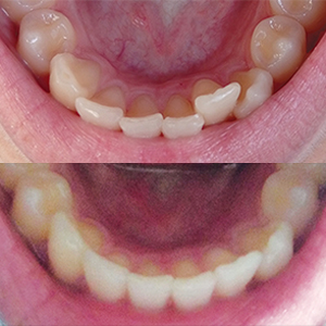 EZ SMILE Results