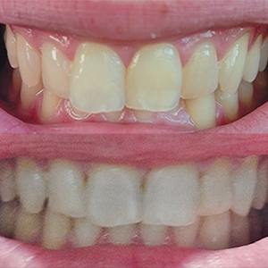 EZ SMILE Results