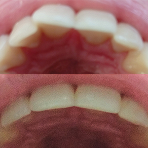 EZ SMILE Results