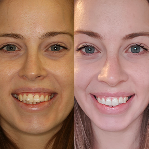 EZ SMILE Results