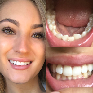 EZ SMILE Results