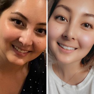 EZ SMILE Results