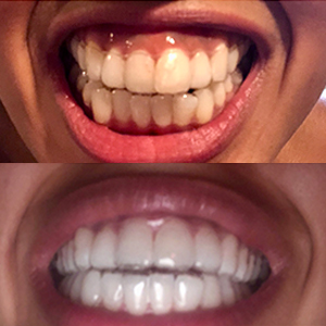 EZ SMILE Results