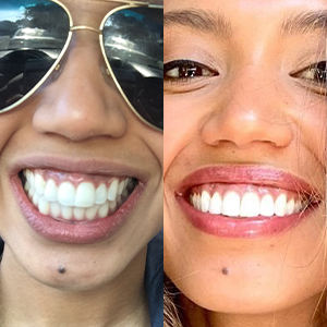 EZ SMILE Results