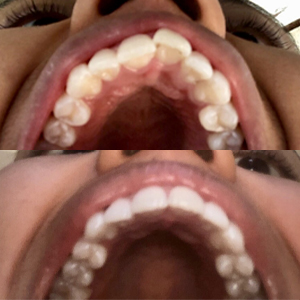 EZ SMILE Results