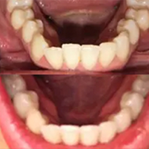 EZ SMILE Results