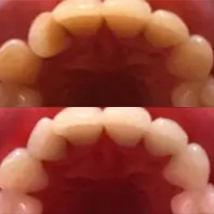 EZ SMILE Results