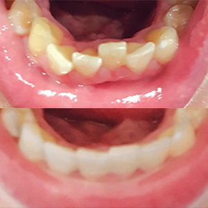 EZ SMILE Results