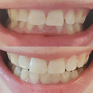 EZ SMILE Results