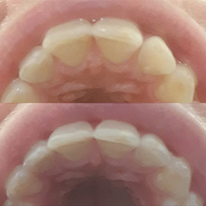 EZ SMILE Results