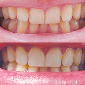 EZ SMILE Results