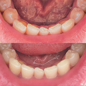 EZ SMILE Results