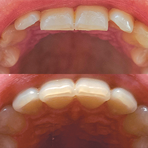 EZ SMILE Results