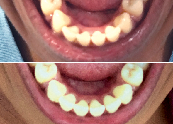 Diana Lower Teeth