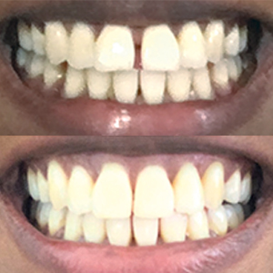 EZ SMILE Results