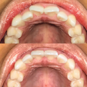 EZ SMILE Results