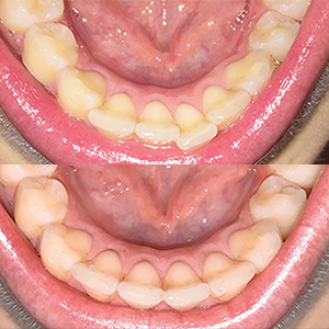 EZ SMILE Results
