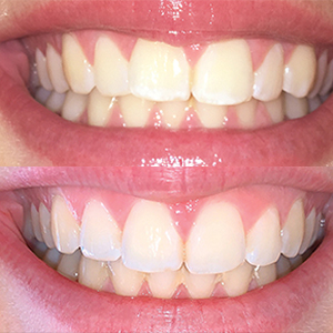 EZ SMILE Results