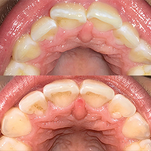 EZ SMILE Results