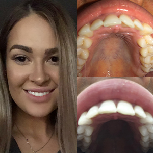 EZ SMILE Results