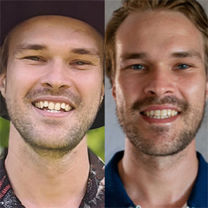 EZ SMILE Results