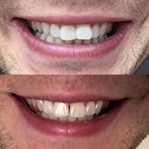 EZ SMILE Results