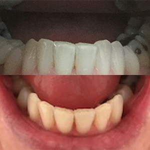 EZ SMILE Results