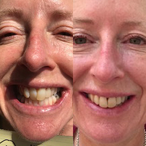 EZ SMILE Results