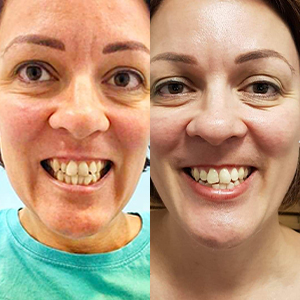 EZ SMILE Results