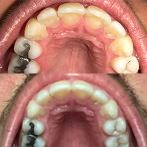 EZ SMILE Results