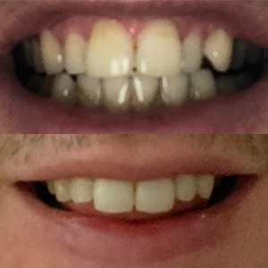 EZ SMILE Results