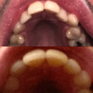 EZ SMILE Results