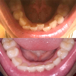 EZ SMILE Results
