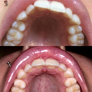 EZ SMILE Results