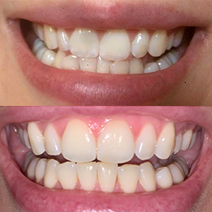 EZ SMILE Results