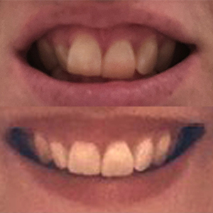 EZ SMILE Results