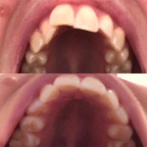 EZ SMILE Results