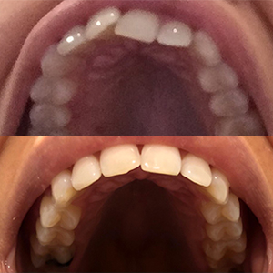 EZ SMILE Results