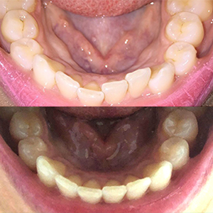 EZ SMILE Results