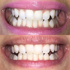EZ SMILE Results