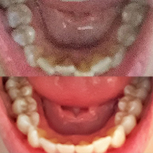 EZ SMILE Results