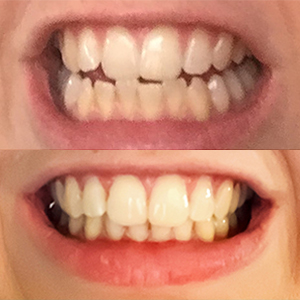 EZ SMILE Results