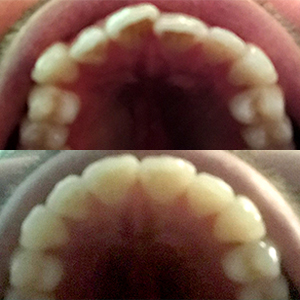 EZ SMILE Results