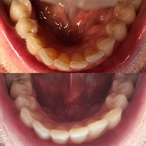 EZ SMILE Results