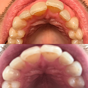 EZ SMILE Results