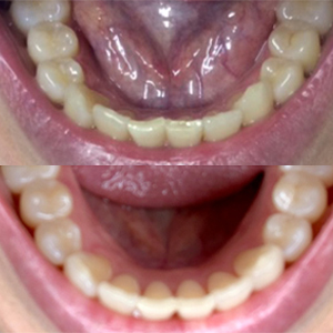 EZ SMILE Results