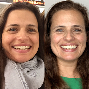 EZ SMILE Results