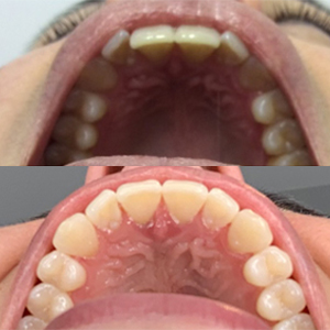 EZ SMILE Results